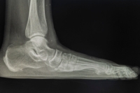 Understanding Flatfoot and Its Impact on Mobility