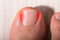 How to Identify an Ingrown Toenail