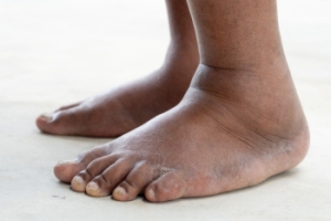 Swollen Feet During Pregnancy Is Common