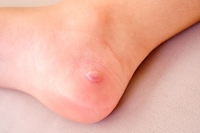 Causes of Blisters in Ballet Dancers