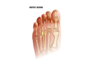 Understanding Morton’s Neuroma