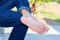 Plantar Warts in Children