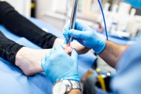 Explaining Laser Treatment for Fungal Toenails